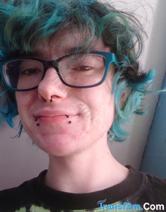 transgender (FTM) top surgery Leeds Tommy