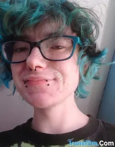transgender (FTM) top surgery Leeds Tommy